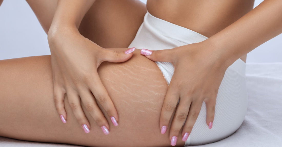 Top 3 Natural Oils To Treat Stretch Marks Easily