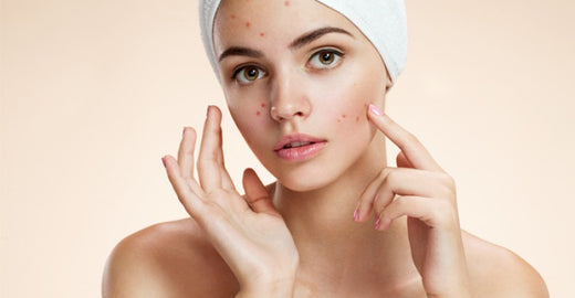 How to remove Pimples?