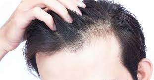 What is Alopecia-areata? How to tackle it?